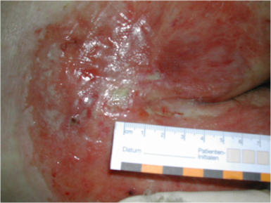 Foto Wunde Inkontinenz Assoziierte Dermatitis (IAD)
