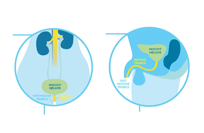 močová trubice