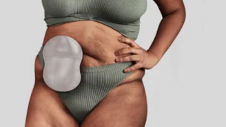 a woman showing her ostomy pouch