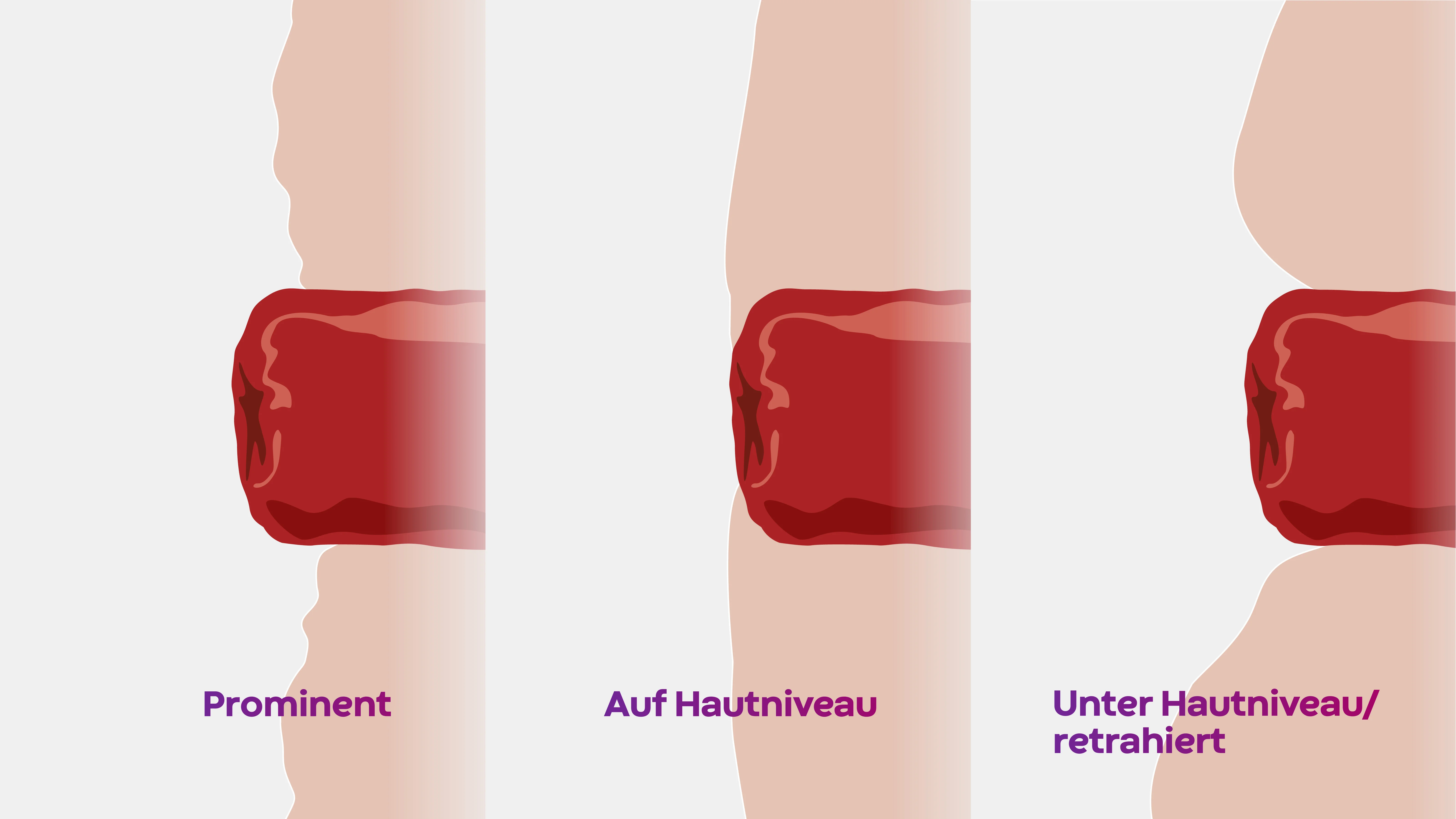 Verschiedene Stomalagen