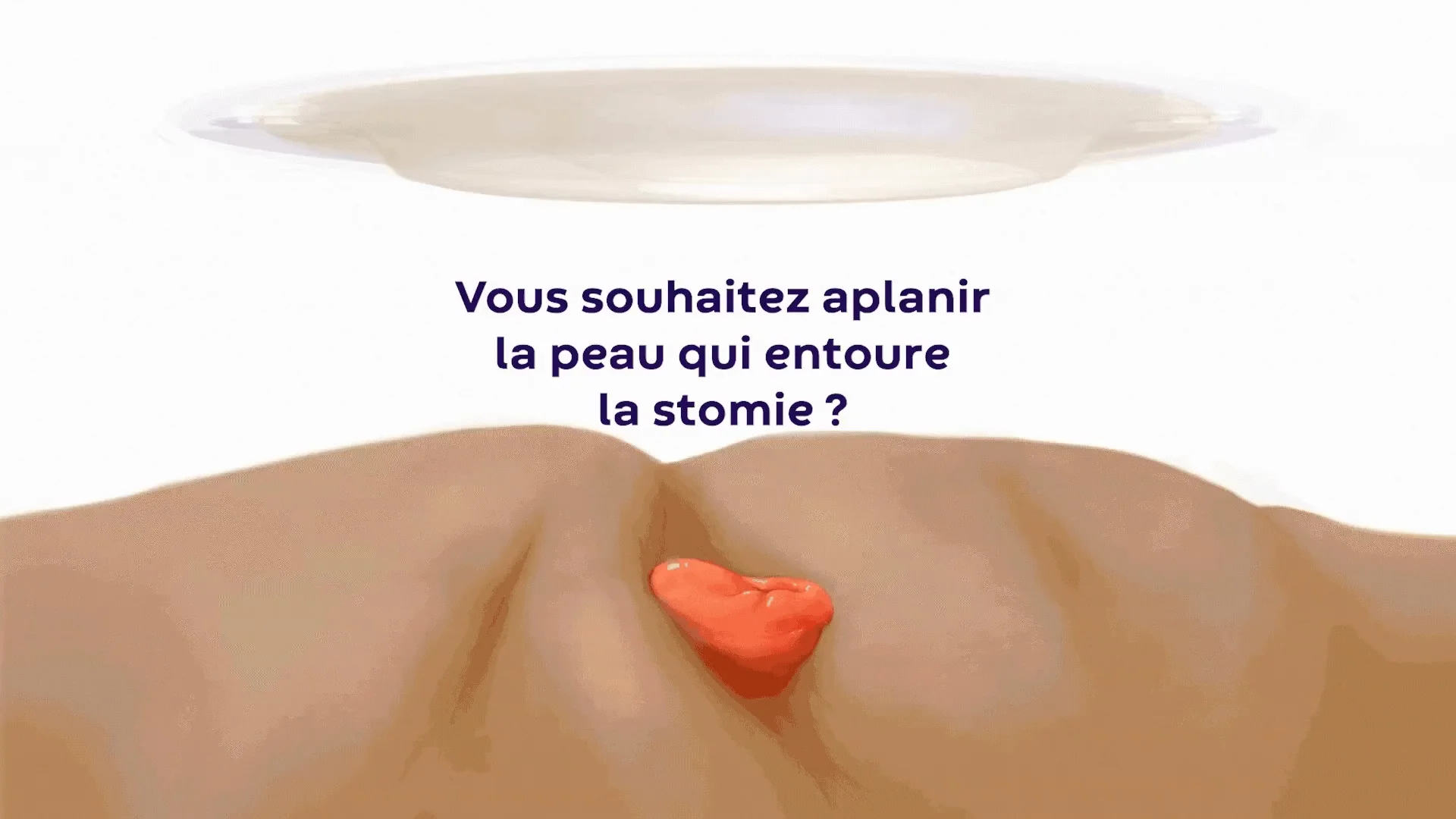 Vidéo montrant comment un appareillage convexe peut lisser la peau autour de la stomie