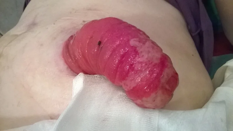 Stomia wypadająca ze zmianami nadżerkowymi